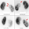 DMSA Renal Scan : Right Pyelonephrytis