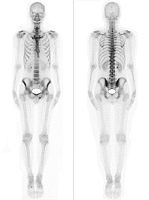 Normal Bone Scan